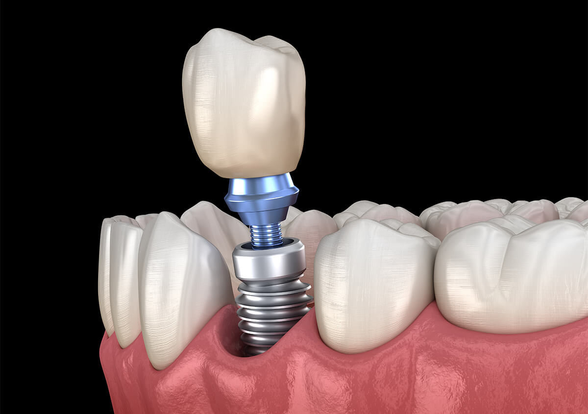 Dental Implant Surgery in Claremont CA Area